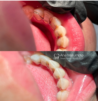 Antes e depois — limpeza dental